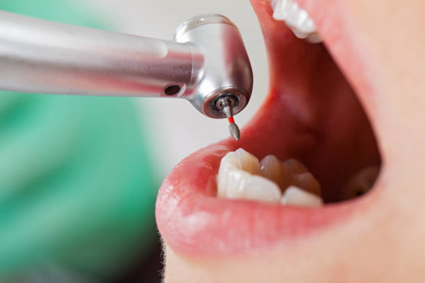 Best Emergency Dentist for Lost Fillings or Crowns in Portsmouth, OH